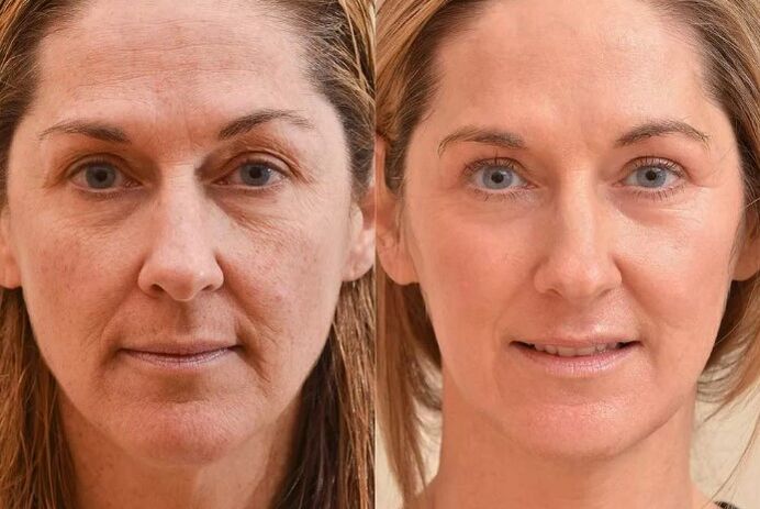 Facial rejuvenation before and after