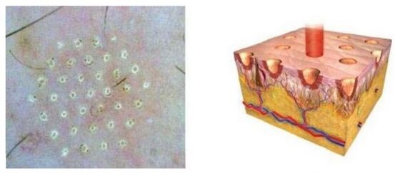 Fractional laser affects the skin point