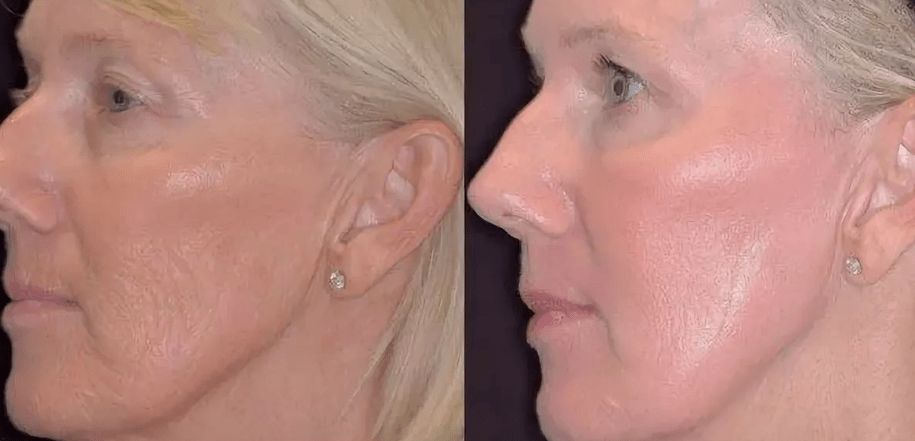 Laser photothetermolysis before and after