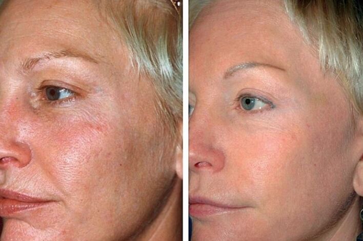 Before and after rejuvenation process
