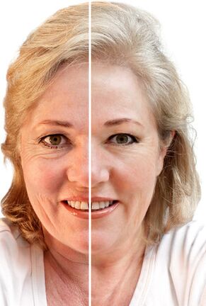 Facial rejuvenation