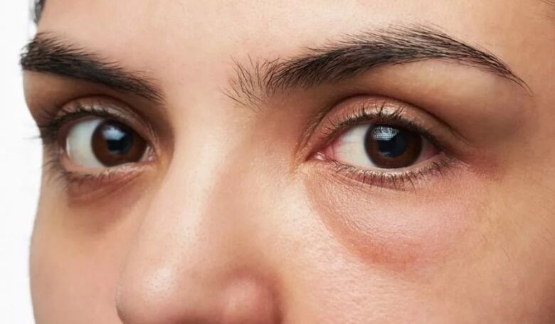 Bags under the eyes, swelling