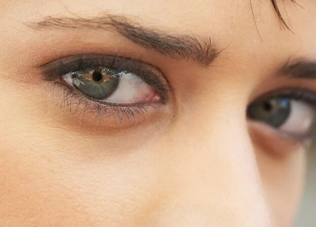 Dark circles under the eyes