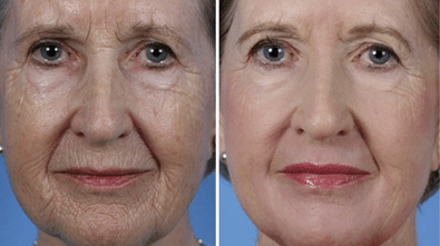 fractional facial skin rejuvenation before and after photo