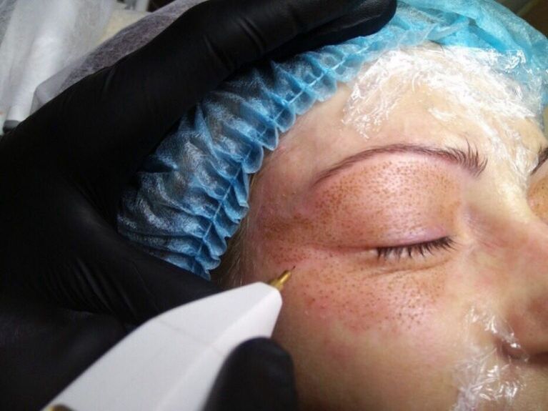 Plasma lifting procedure