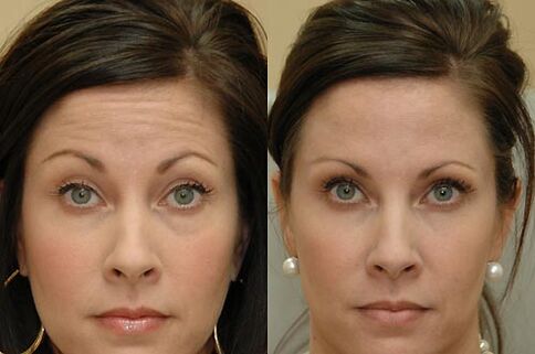 Botulinum toxin injections are suitable for use on any area of ​​the face