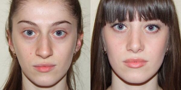A girl before and after plasma facial skin rejuvenation