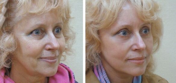 A woman before and after plasma facial skin rejuvenation