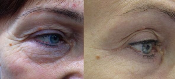 The result of effective plasma rejuvenation of the eye area
